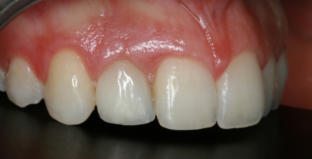 Implante y ortodoncia